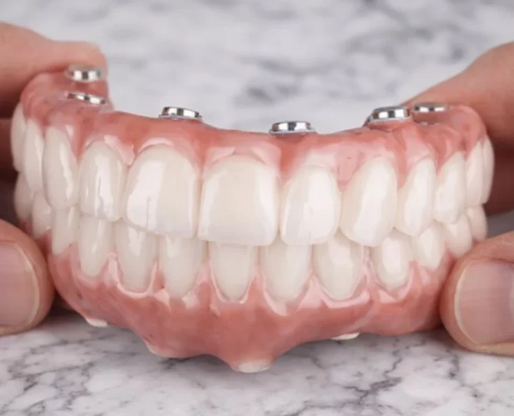 Illustration: a full-arch bridge attaching to four implants