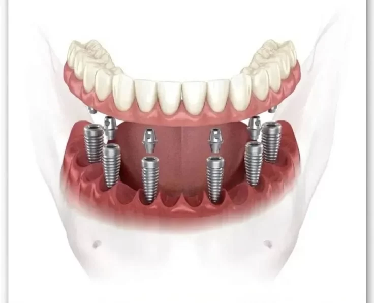 Illustration: a full-arch bridge supported by six implants